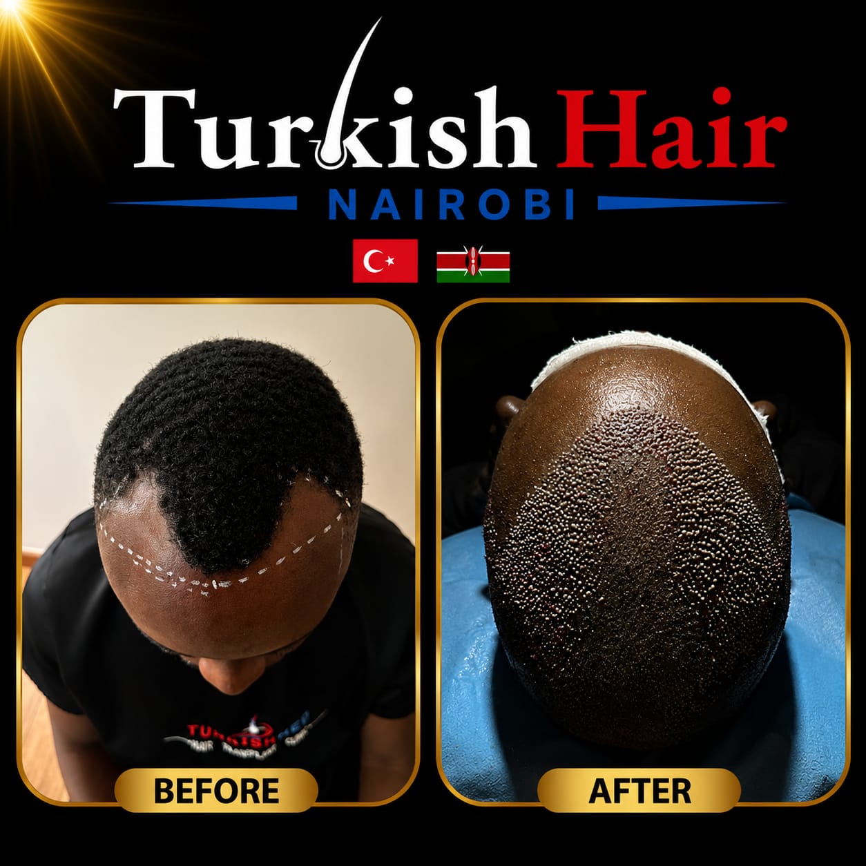 Turkish Hair Nairobi Case 8